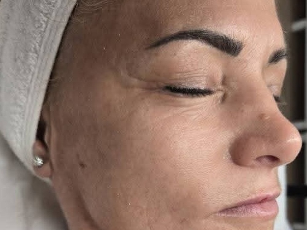 Anti-aging kezelés előtt